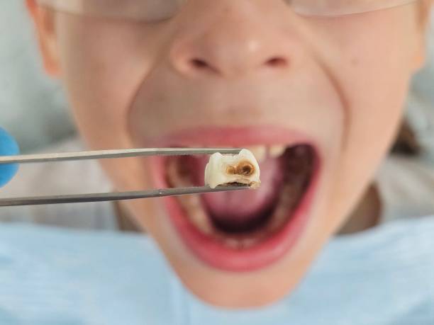 Best Emergency Tooth Extraction in West Siloam Springs, OK